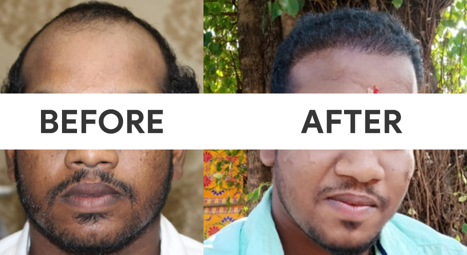 Hair Transplant in Cochin |Hair Transplantation Clinic in Kochi- Medlounges